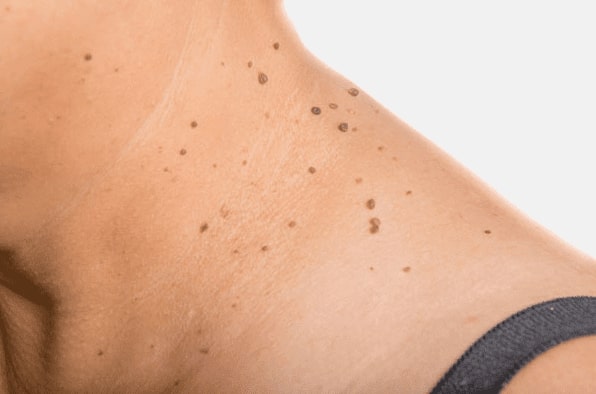 Are you looking for easy skin tag removal Stockwood - then contact Spire today!