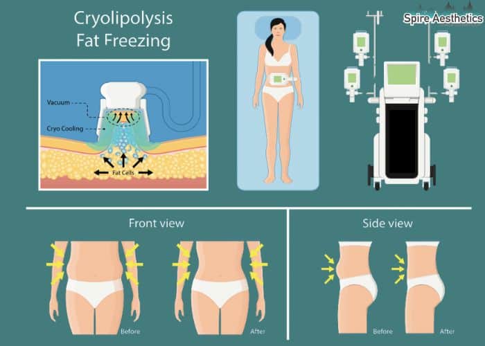 Image of diet and fat freezing combined for best results for Spire Aesthetics Stockwood